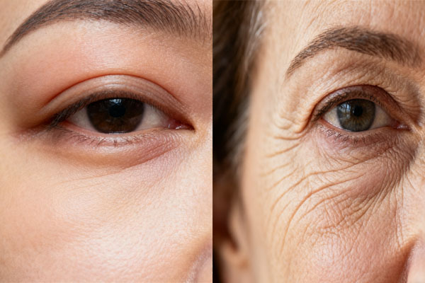 A close-up showing the difference between puffiness and wrinkles around the eye area