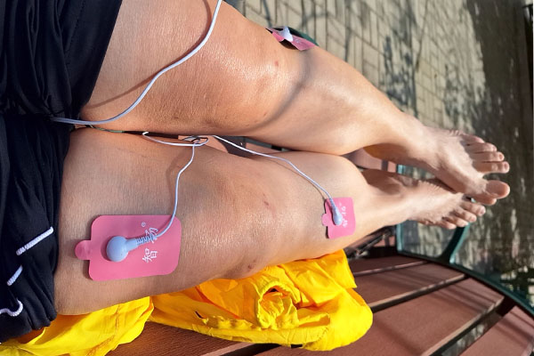 An illustration of a TENS unit with pads placed along the path of the sciatic nerve on a leg