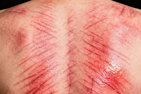 An image illustrating skin irritation or redness from overuse